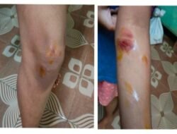 चिपळूण : भटक्या कुत्र्यांच्या झुंडीचा विद्यार्थिनीवर हल्ला; गटारात पडून जखमी