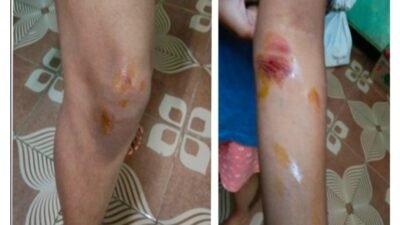 चिपळूण : भटक्या कुत्र्यांच्या झुंडीचा विद्यार्थिनीवर हल्ला; गटारात पडून जखमी