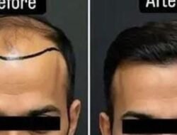 चिपळूण : स्प्रिंग क्लिनिक चिपळूण येथे अत्याधुनिक हेअर ट्रान्सप्लांट सुविधा उपलब्ध, आंतरराष्ट्रीय दर्जाच्या तंत्रज्ञानाच्या साहाय्याने नैसर्गिक, सुरक्षित आणि प्रभावी केस प्रत्यारोपण उपचार