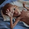 रत्नागिरीत कुपोषणाचे गंभीर वास्तव! 390 बालके अति तीव्र, तर 2,952 बालके मध्यम कुपोषित